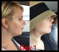 Chin Liposuction Arkansas Before And Day 1 After