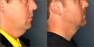 Chin Liposuction By Dr. Alvin B. Cohn MD, Birmingham, AL Plastic Surgeon