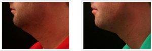 Chin Liposuction By Dr. Gregory Laurence, MD, Surgeon in Germantown, Tennessee (1)