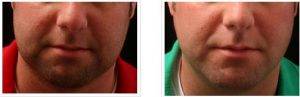 Chin Liposuction By Dr. Gregory Laurence, MD, Surgeon in Germantown, Tennessee (2)
