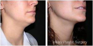 Chin Liposuction By Dr. Jeff Healy, MD, Waimalu, Hawaii Plastic Surgeon (3)