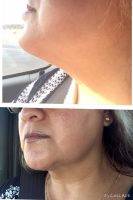 Chin Liposuction Charleston SC Before And After