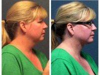 Chin Liposuction In Jacksonville FL Before And After