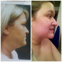 Chin Liposuction Procedure With Dr Andrew Wolfe, Colorado Plastic Surgeon