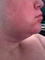 Could Facial Liposuction Help With My Cheeks And Chin