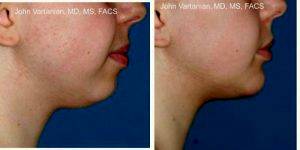 Doctor A. John Vartanian, MD, Glendale Facial Plastic Surgeon - 30 Year Old Woman Treated With Liposuction And Chin Implant