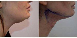 Doctor Dinesh Maini, MBChB, London Physician - 28 Year Old Woman Treated With Smart Lipo