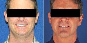 Doctor Kenton Schoonover, MD, Wichita Plastic Surgeon - 46 Year Old Man Treated With Laser Liposuction Of Chin
