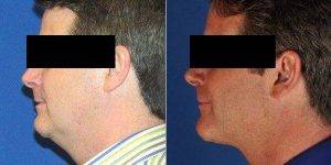 Doctor Kenton Schoonover, MD, Wichita Plastic Surgeon - 46 Year Old Man Treated With Laser Liposuction Of Neck
