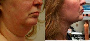 Doctor Lawrence Bundrick, MD, Huntsville Plastic Surgeon - 47 Year Old Woman Treated With Chin Liposuction
