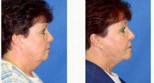 Doctor Melek Kayser, MD, Detroit Plastic Surgeon - 38 Year Old Woman Treated With Liposuction PreOp & PostOp