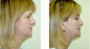 Doctor Randy Proffitt, MD, Mobile Plastic Surgeon - 50 Year Old Woman Treated With Neck Liposuction