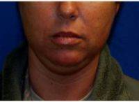 Doctor Sang W. Kim, MD, Syracuse Facial Plastic Surgeon - 34 Year Old Woman Treated With Chin Neck Liposuction Procedure