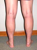 Dr George Marosan, MD, Bellevue Plastic Surgeon - Liposuction Of The Ankles And Calves