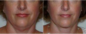 Dr Robert N. Severinac, MD, Fort Wayne Plastic Surgeon - Chin Liposuction Before After