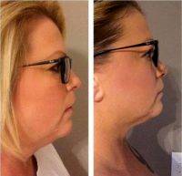 Dr Zachary Filip, Murrieta Plastic Surgeon Chin (neck) Micro Lipo Before And After