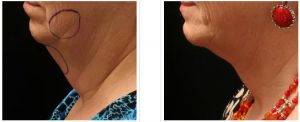 Dr. Gregory Laurence, MD, Surgeon in Germantown, Tennessee - Neck Liposuction