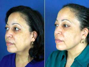 Dr. Jonathan Kulbersh, MD, Charlotte Facial Plastic Surgeon - 45 Yo Female After Neck Liposuction To Improve Her Neckline