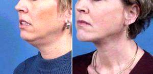 Dr. Louise Ferland, MD, Richmond Plastic Surgeon - Liposuction Procedure Of The Neck And Chin Implant