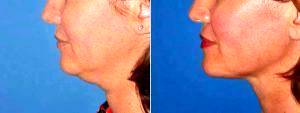 Dr. Ross A. Clevens, MD, Melbourne Facial Plastic Surgeon - SmarLipo To Neck On Female