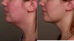 Dr. Scott Chapin, MD, FACS, Philadelphia Plastic Surgeon - 36 Year Old Had SmartLipo Treatment To Her Neck In The Office Setting