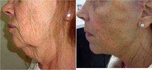 Facelift And Neck Liposuction Procedure Performed In Office Before & After By Doctor Shawn Allen, MD, Boulder Dermatologist