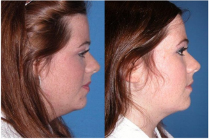 Female Chin Lipo By Dr. Michael Devlin - Cosmetic Surgeon In Little Rock, Arkansas