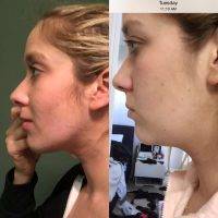 Lipo For The Face Before And After