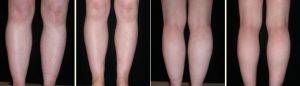 Lipoplasty Of Ankles By Dr. Shahram Salemy, MD, FACS, Seattle Plastic Surgeon