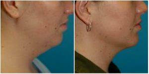 Liposuction Of The Fat Under Her Chin And Jawline By Dr. D'arcy A. Honeycutt, MD, Bismarck, North Dakota Plastic Surgeon