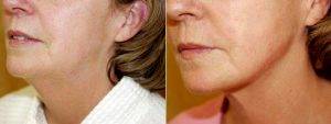 Liposuction Procedure Before & After By Dr. Elizabeth F. Rostan, MD, Charlotte Dermatologist