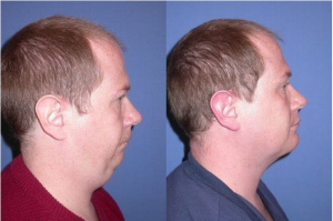 Male Chin Lipo By Dr. Michael Devlin - Cosmetic Surgeon In Little Rock, AR