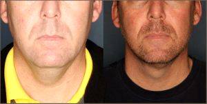 Male Facial Liposuction By Dr. Alvin B. Cohn MD, Birmingham, AL Plastic Surgeon