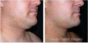 Neck Liposuction By Dr. Jeff Healy, MD, Waimalu, Hawaii Plastic Surgeon (1)