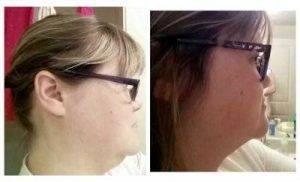 Neck Liposuction Minneapolis Before And After Photos
