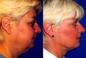 Neck Liposuction Procedure Before & After By Dr. Victor Ferrari, MD, FACS, Charlotte Plastic Surgeon