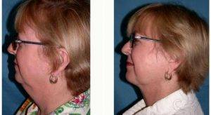 Neck Liposuction Procedure Before & After With Doctor Suzanne M. Quardt, MD, Palm Springs Plastic Surgeon