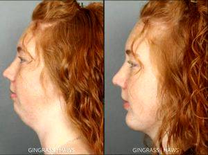 Patient underwent placement of chin implant with chin liposuction by Dr. Melinda Haws, Nashville, TN Plastic Surgeon (1)