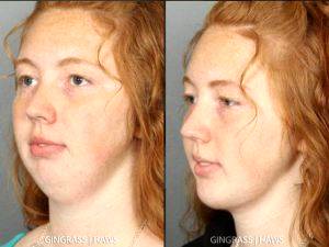 Patient underwent placement of chin implant with chin liposuction by Dr. Melinda Haws, Nashville, TN Plastic Surgeon (2)
