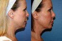 Smart Lipo MPX Neck Liposuction With Doctor Francisco Canales, MD, Santa Rosa Plastic Surgeon