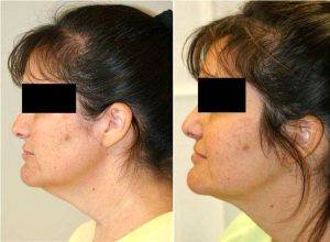 SmartLipo Neck Left Lateral View Before & After With Dr Theodore Katz, MD, FACS, Philadelphia Plastic Surgeon