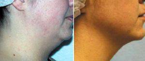 SmartLipo Of Neck Before & After With Dr Michael Gold, MD, Nashville Dermatologic Surgeon