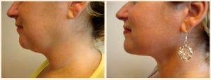 Tumescent Liposuction Of The Chin, Cheeks, And Jowls By Dr. A. Bonelli, MD, Safety Harbor, Florida Plastic Surgeon (1)