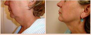 Tumescent Liposuction Of The Chin, Cheeks, And Jowls By Dr. A. Bonelli, MD, Safety Harbor, Florida Plastic Surgeon (3)