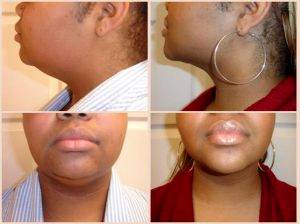 Tumescent Liposuction Of The Chin, Cheeks, And Jowls By Dr. A. Bonelli, MD, Safety Harbor, Florida Plastic Surgeon (4)