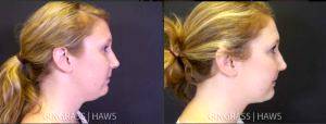liposuction of the chin with Dr. Mary Gingrass, Nashville, TN Plastic Surgeon (1)