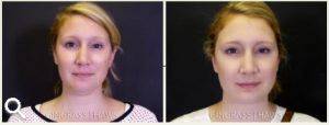 liposuction of the chin with Dr. Mary Gingrass, Nashville, TN Plastic Surgeon (2)