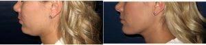 29 Year Old Woman Treated With Chin Liposuction Before & After With Dr. David M. Creech, MD, Chandler Plastic Surgeon