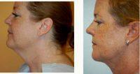 37 Year Old Woman Treated With Smart Lipo To The Chin And Neck Before & After By Dr. Bhupesh Vasisht, MD, Voorhees Plastic Surgeon