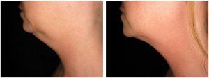 Chin Lipo By Dr George P. Chatson, M.D., Plastic Surgeon In North Andover, Massachusetts (Andover Plastic Surgery)